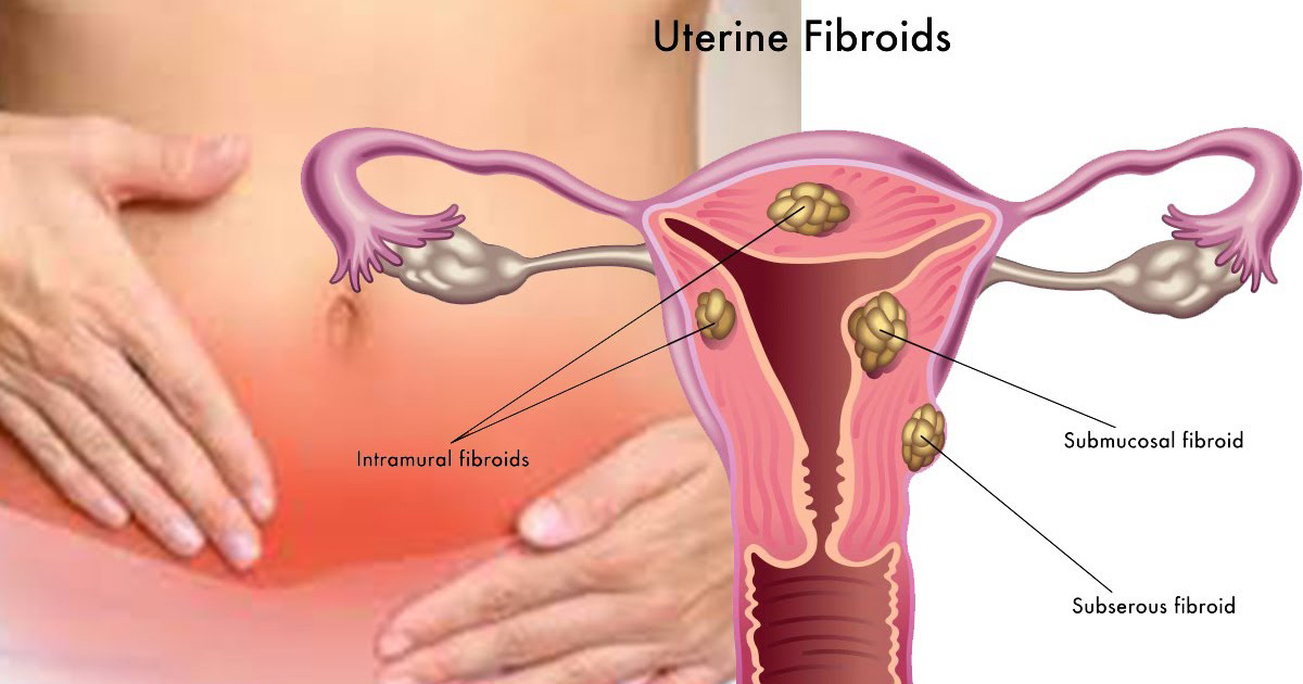 Underutilized nonsurgical treatment for uterine fibroids - Parsemus Foundation