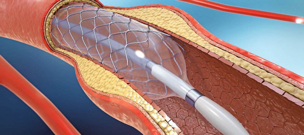 Cardiac stent procedure