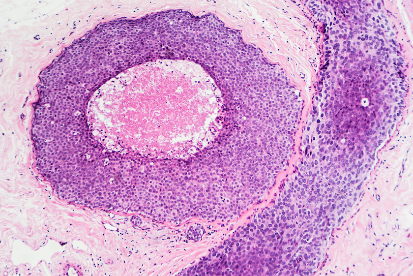 Advanced ductal carcinoma in situ