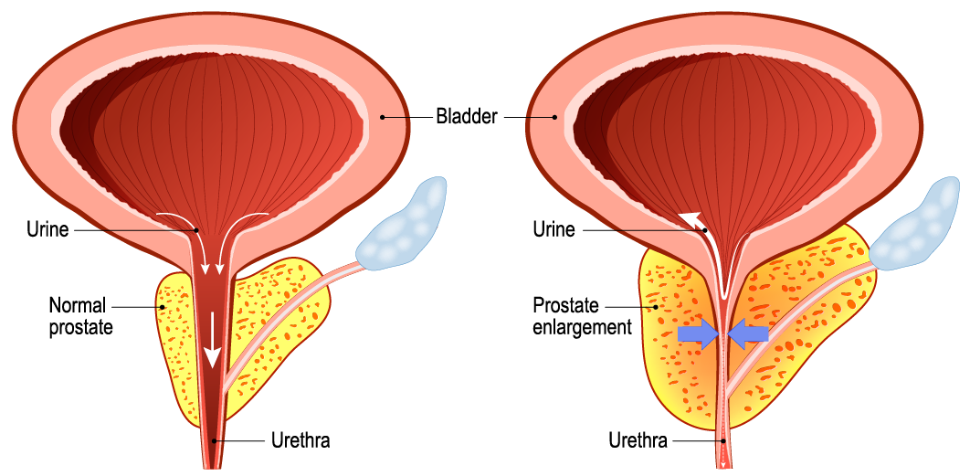 BPH prostate enlargement