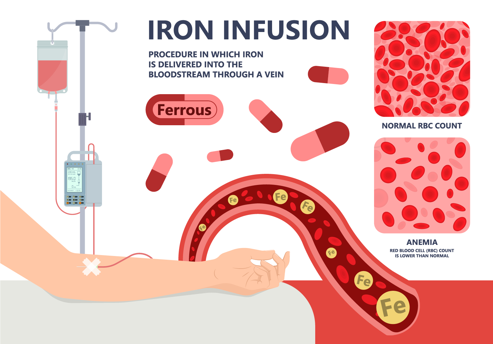 Infographic about iron deficiency