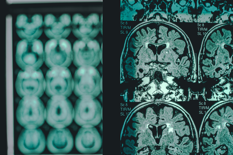 Alzheimer's disease on MRI 2