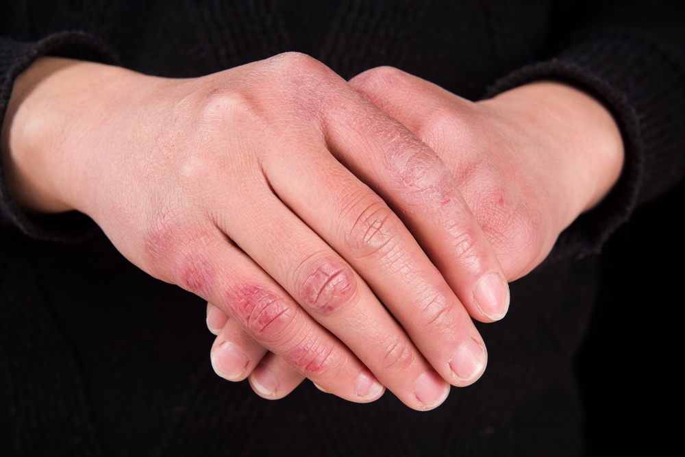 Chilblains on a woman's hands