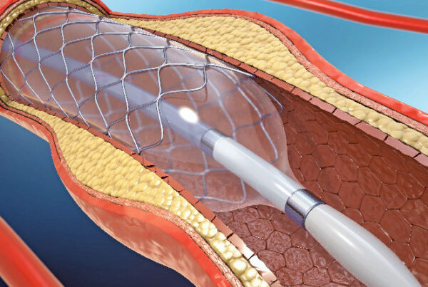 Angioplasty: Ending Inappropriate Use