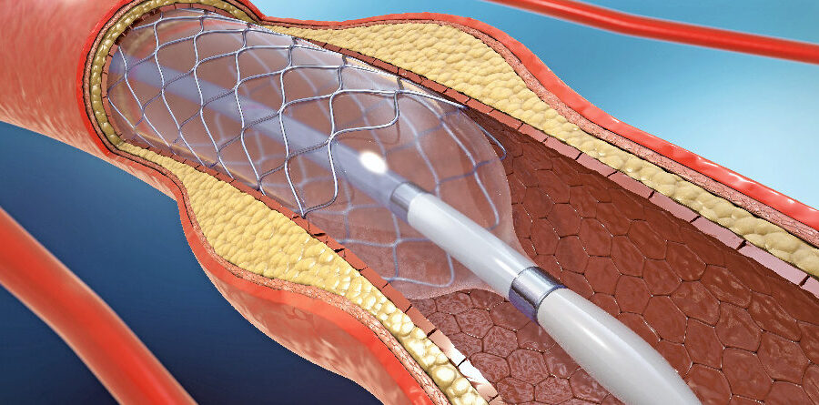 Angioplasty: Ending Inappropriate Use