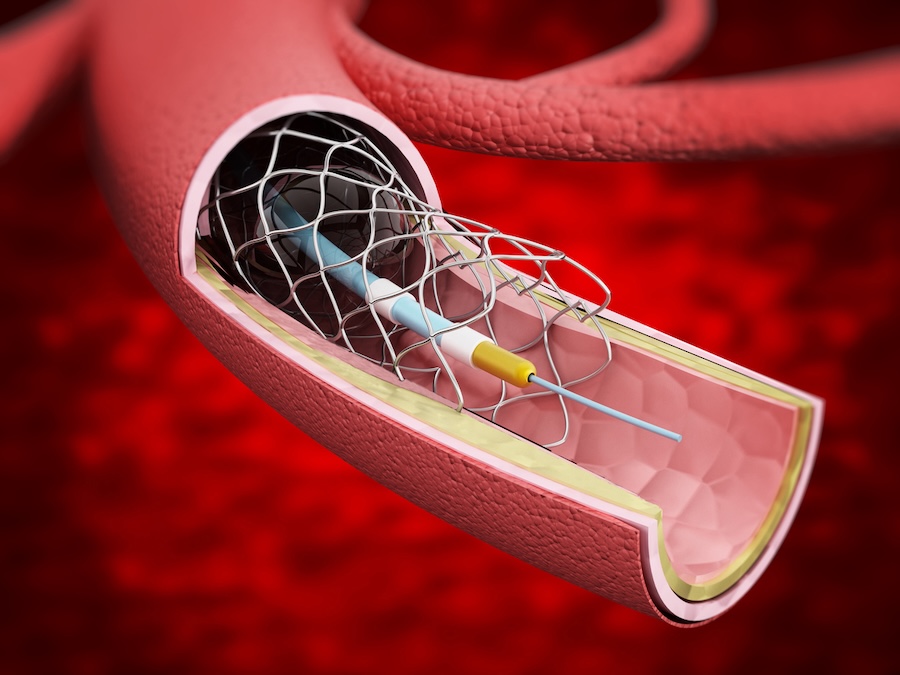 Stents one of most overused medical interventions