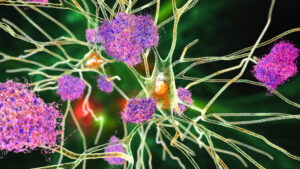 Neurons with Alzheimer's disease