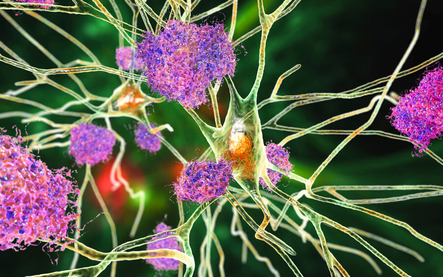 Neurons with Alzheimer's disease