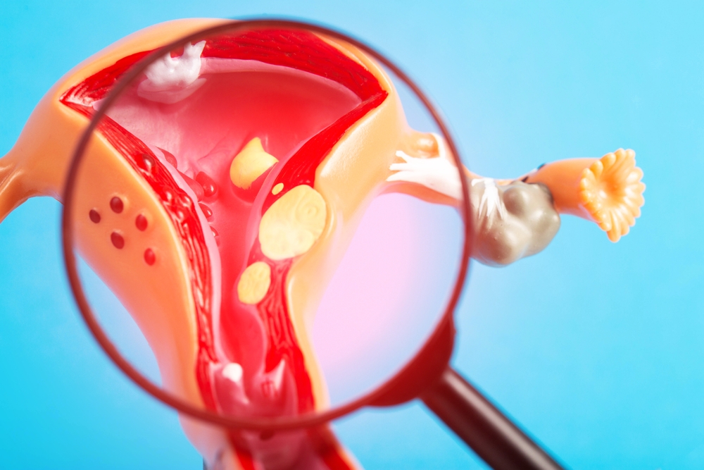 Underutilized nonsurgical treatment for uterine fibroids